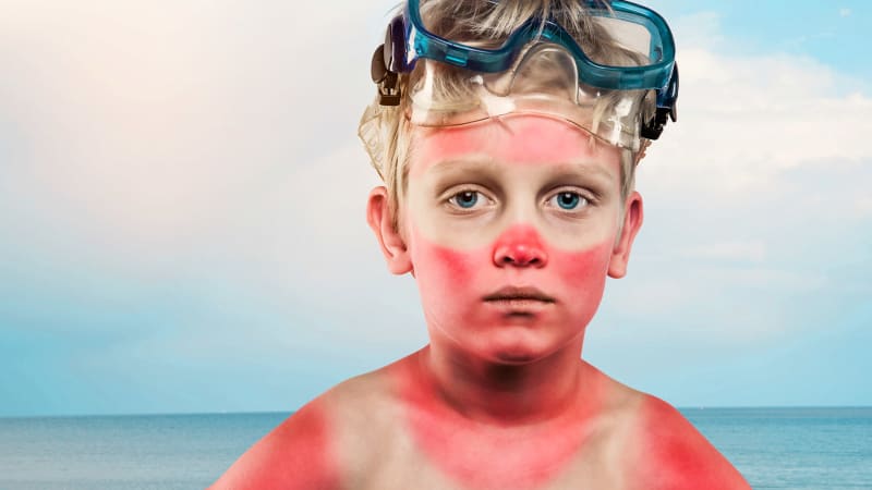K rakovině kůže stačí pár spálení na sluníčku. Ročně ohrozí 30 000 Čechů