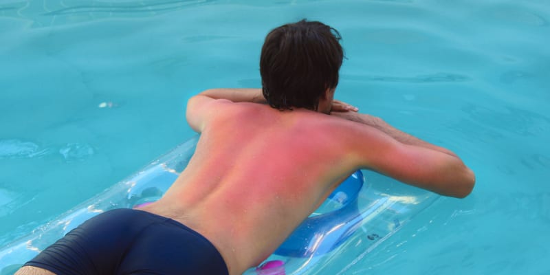 Spálení kůže je typické pro bazénové povaleče