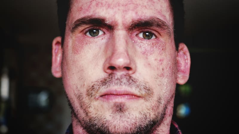 Původce planých neštovic může způsobit i ochrnutí obličeje
