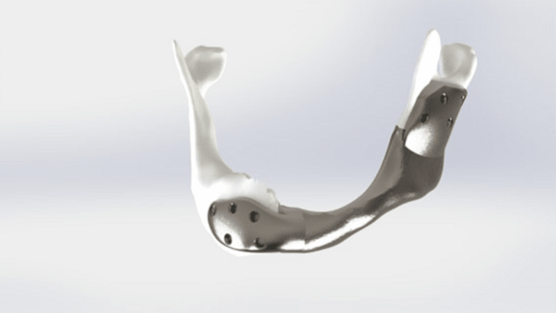 Titanová čelist vytvořená na 3D tiskárně 