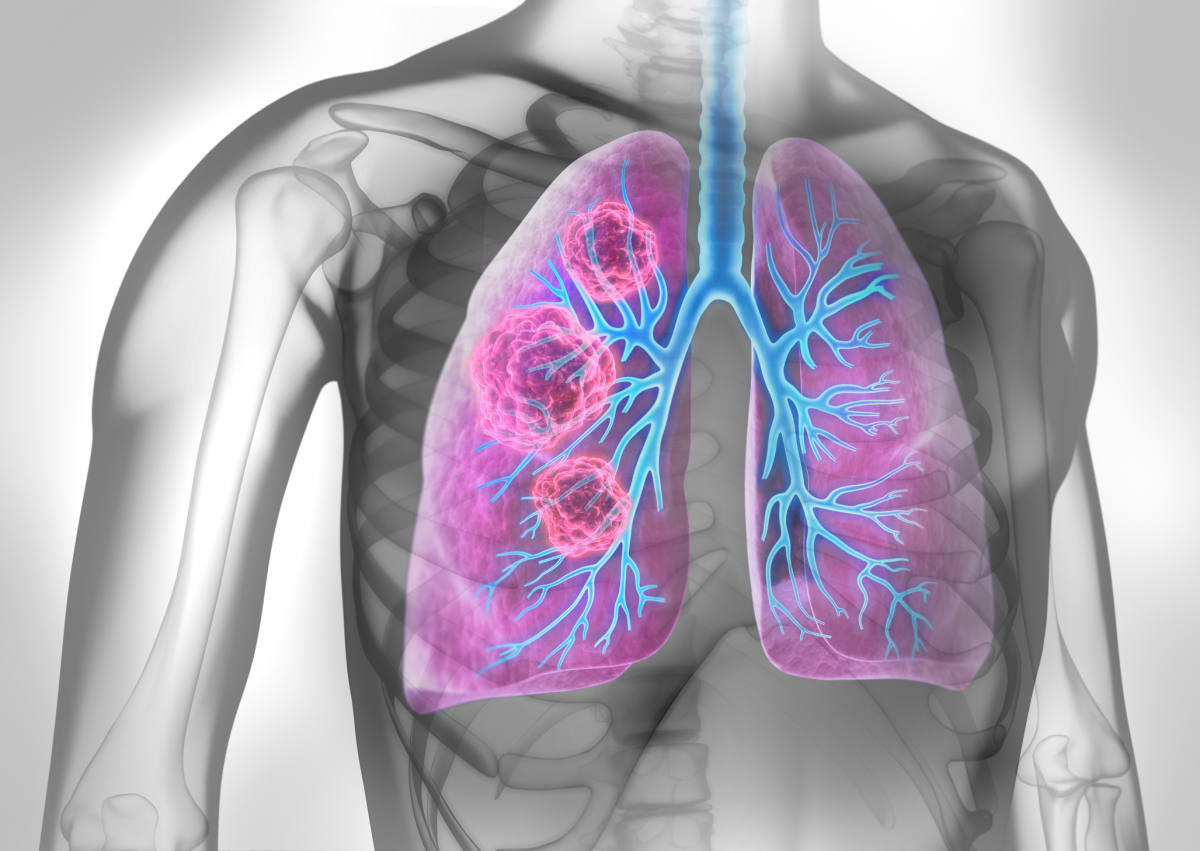 Rakovina plic je častým typem onemocnění