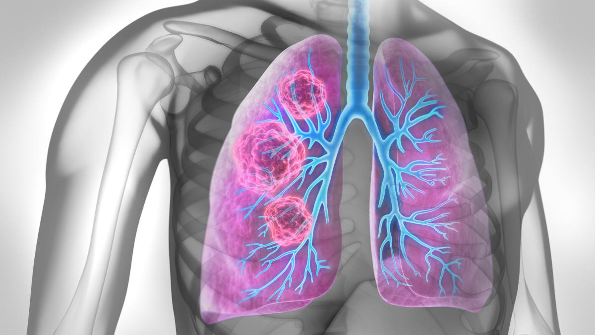 Rakovina plic je častým typem onemocnění.