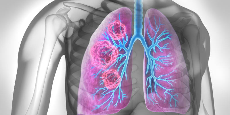 Rakovina plic je častým typem onemocnění