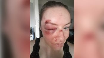 Brutální napadení kvůli banálnímu dotazu. Kateřinu zbil na zastávce v Plzni neznámý muž