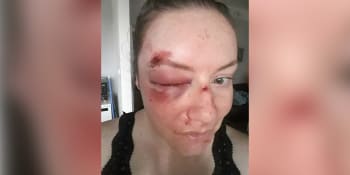 Brutální napadení kvůli banálnímu dotazu. Kateřinu zbil na zastávce v Plzni neznámý muž
