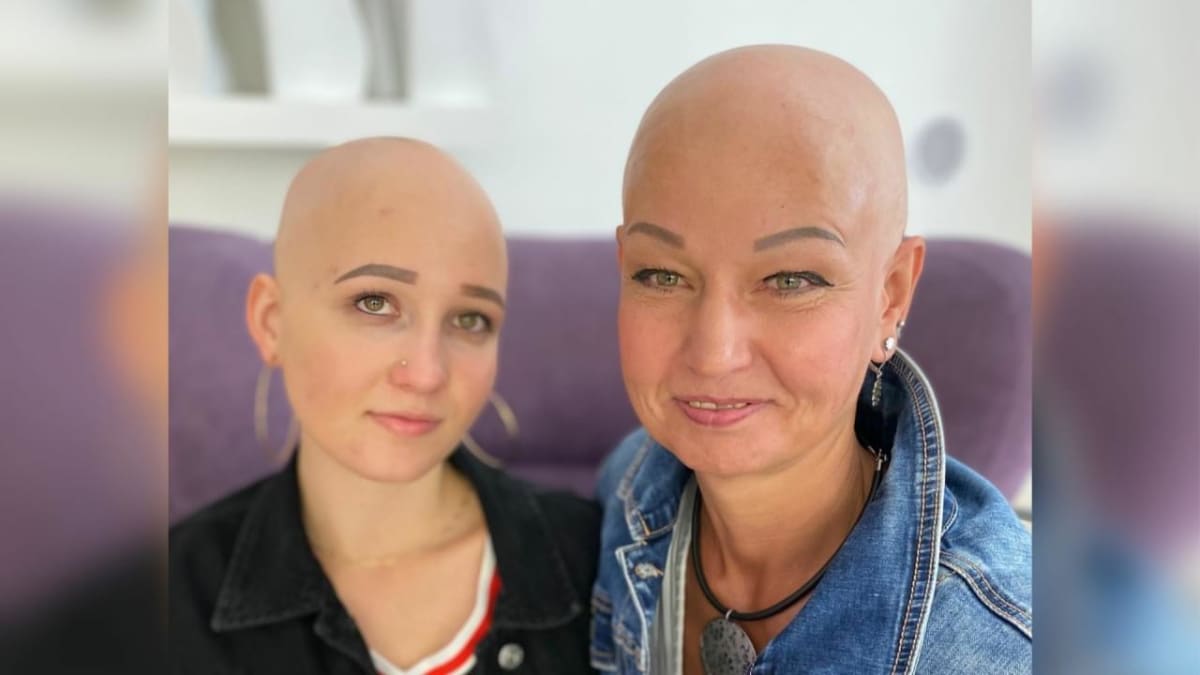 Marcela s Kristýnou trpí alopecií.