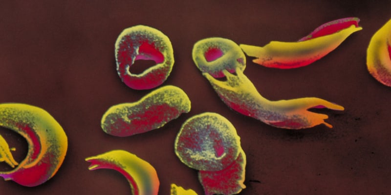 Červené krvinky při onemocnění srpkovitou anémií