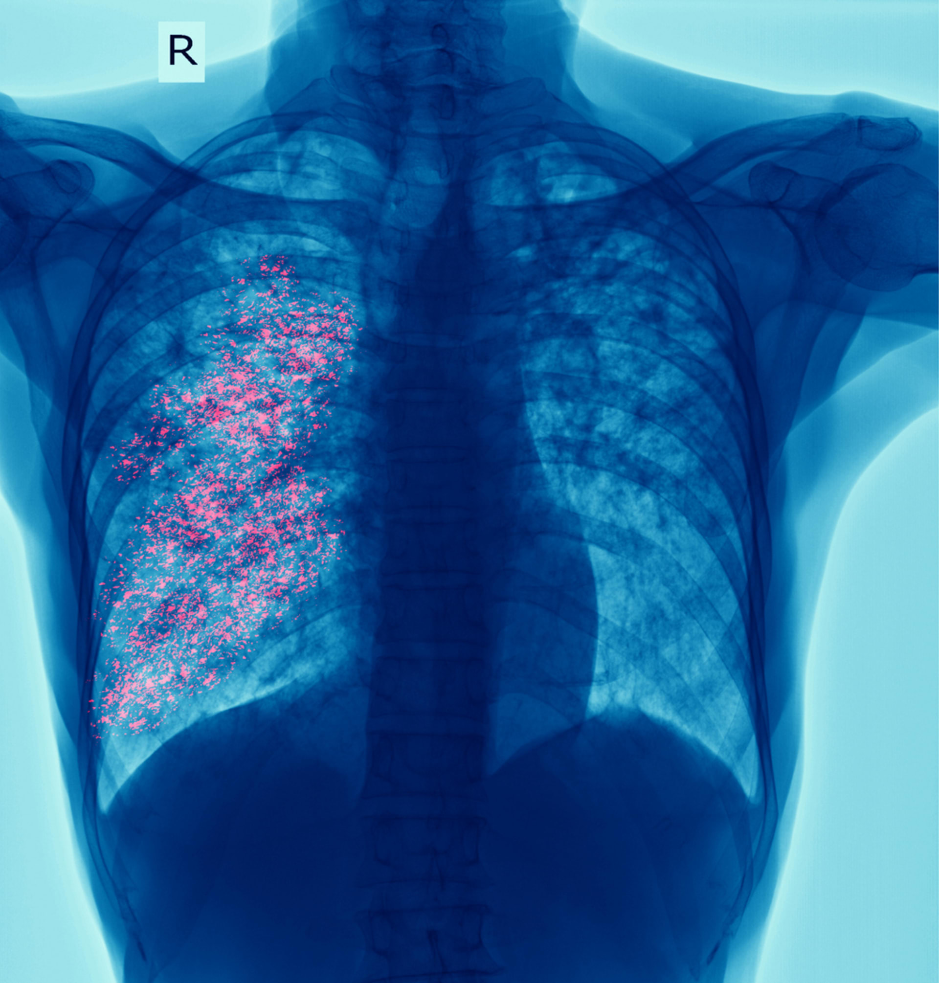 RS virus může způsobit nebezpečný zápal plic