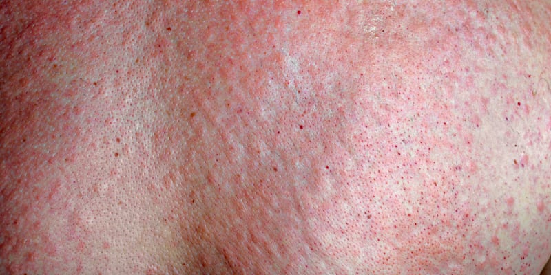 Kopřivka je jedním z nejčastějších projevů alergie na chlad