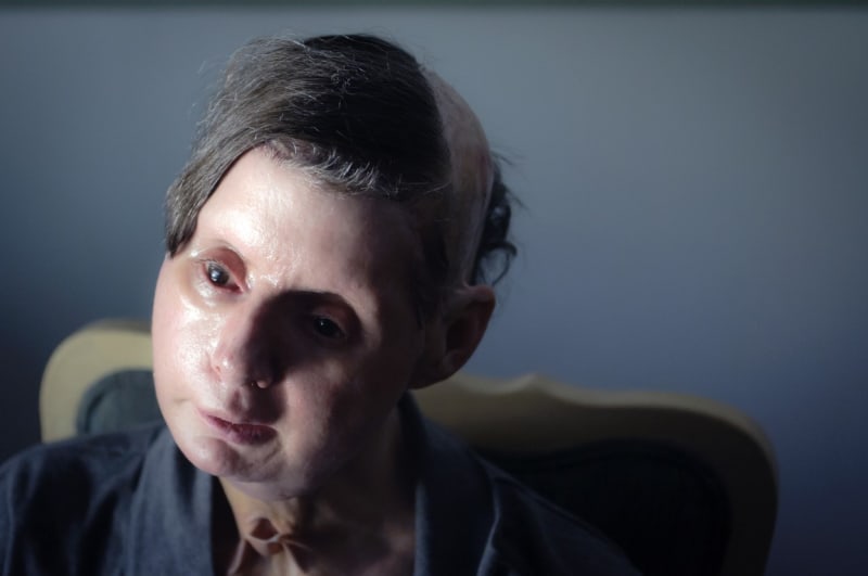 Charla Nashová po transplantaci obličeje