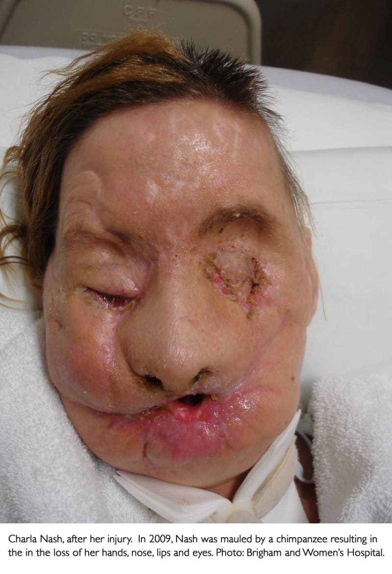 Charla Nashová před transplantací obličeje