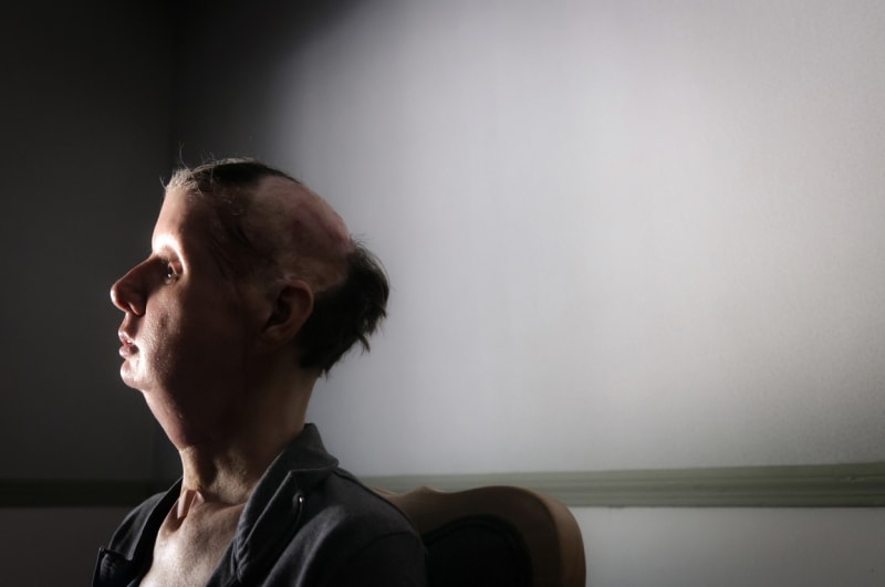 Charla Nashová po transplantaci obličeje