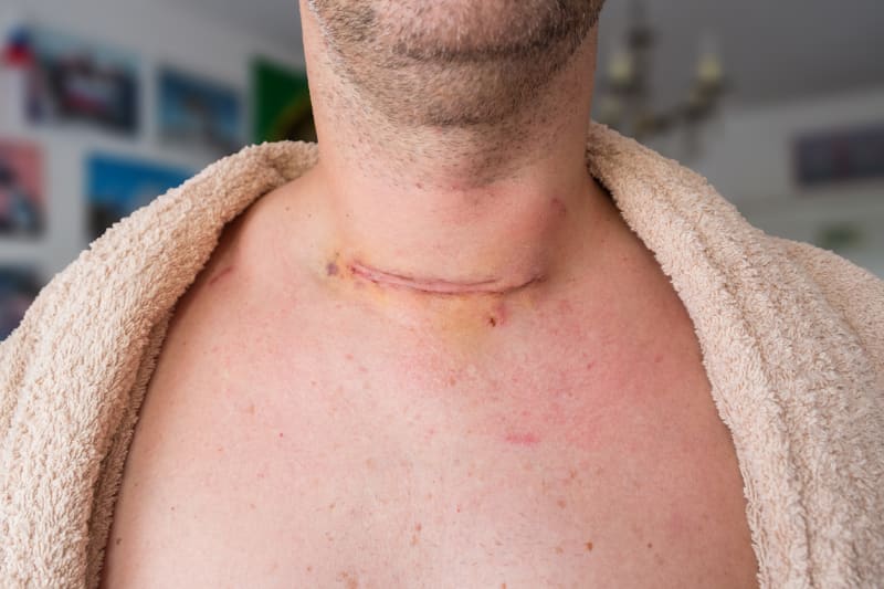Muž po operaci nádoru štítné žlázy