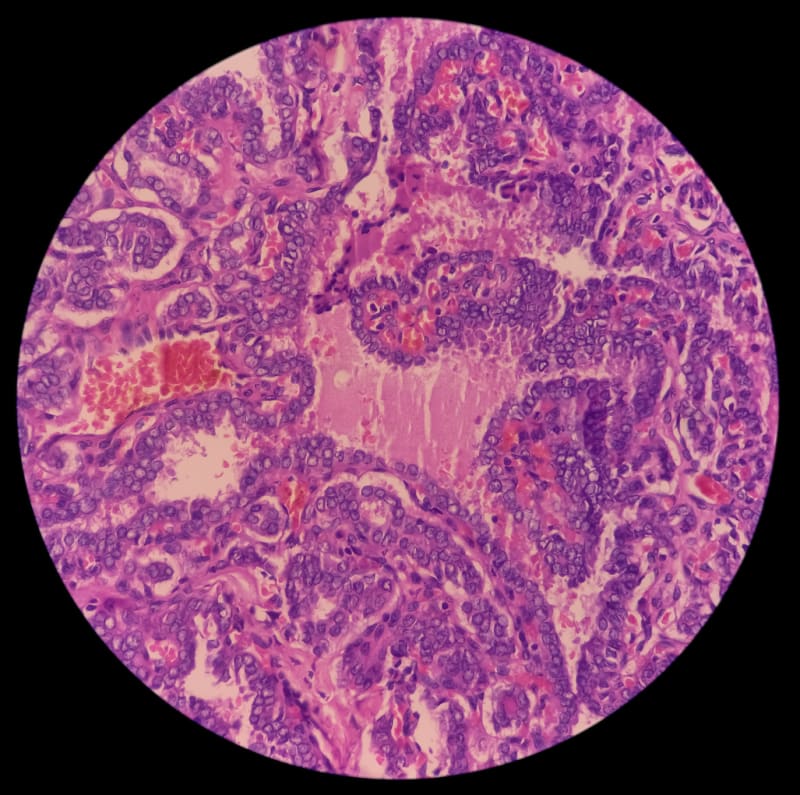 Rakovina štítné žlázy pod mikroskopem
