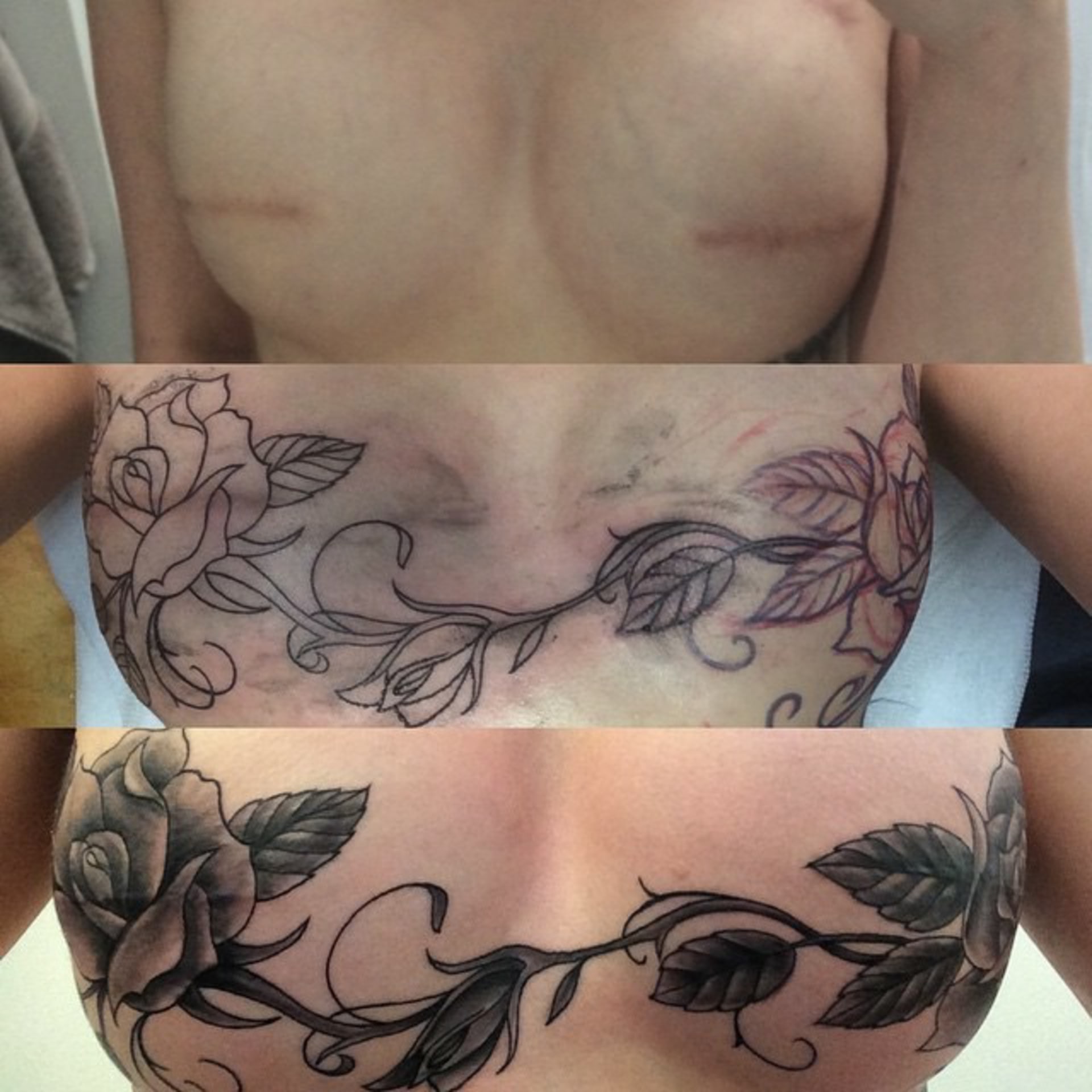 Tetování po mastektomii