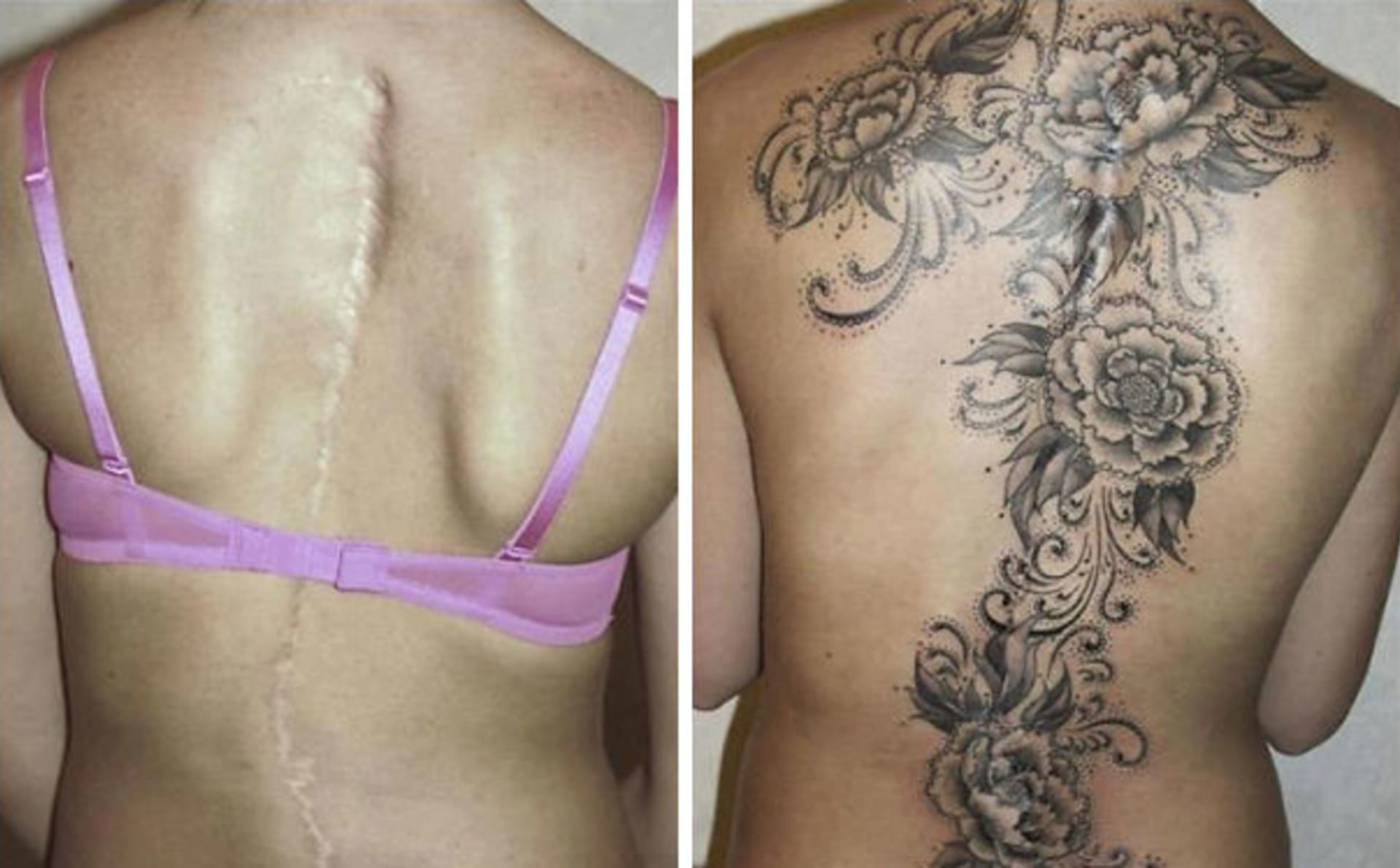 Nekteré jizvy vyžadují velká tetování, která zakryjí třeba celá prsa, břicho či záda.