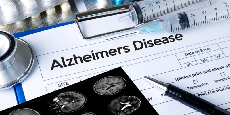 Nález na mladíkově mozku odpovídá Alzheimerově chorobě