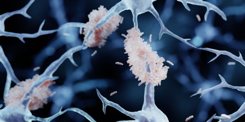 Amyloidní plaky u Alzheimerovy choroby 