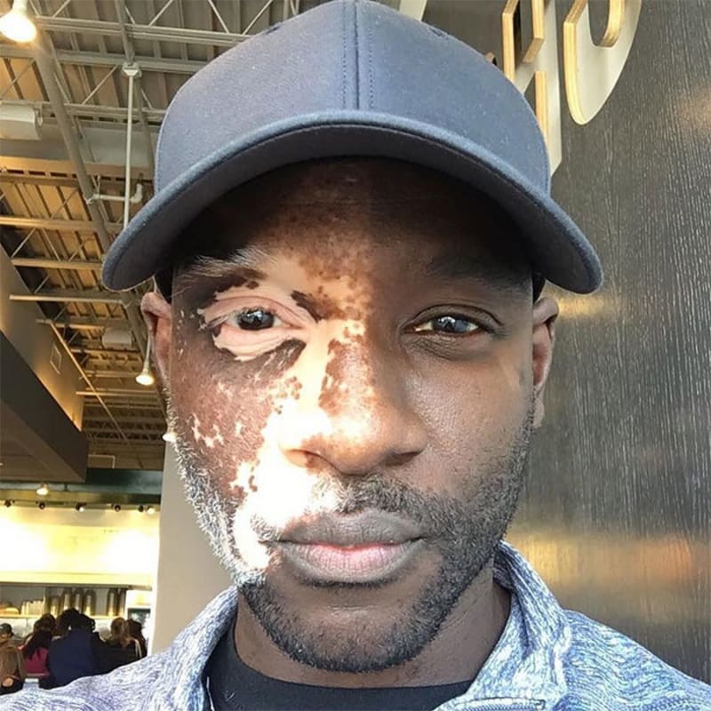 Vitiligo neboli ztráta kožního pigmentu může být opravdu výrazná