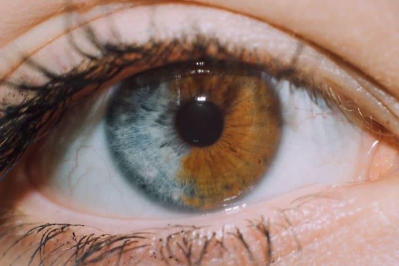 Kamarád, který má částečnou heterochromii - různobarevnost duhovky v rámci jednoho oka