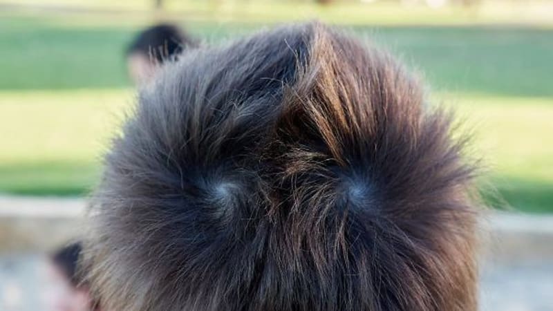Díky genetice má dva víry vlasů na temeni, takže mu rostou na celé hlavě symetricky