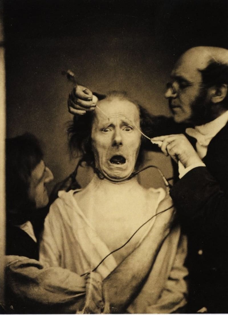 Neurolog dává pacientovy elektrošoky do tváře, aby zjistil funkčnost mimických svalů (1862)