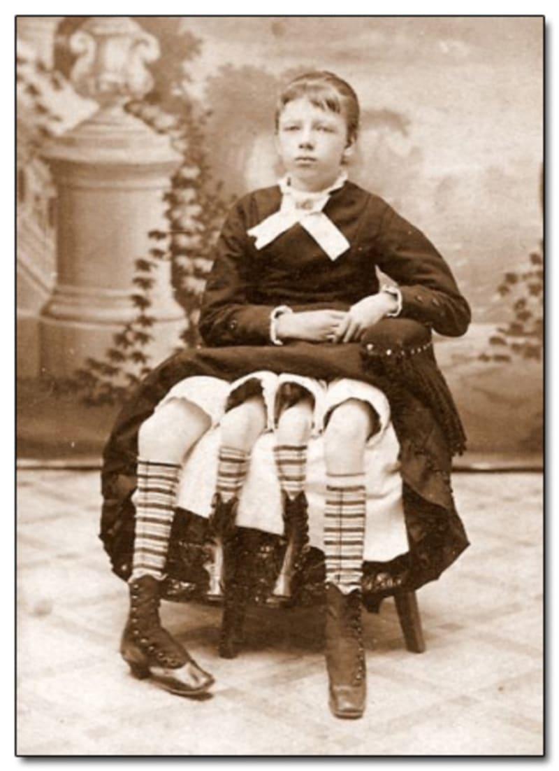 Myrtle Corbin se narodila roku 1868 s extra končetinami a sloužila jako atrakce v cirkusu