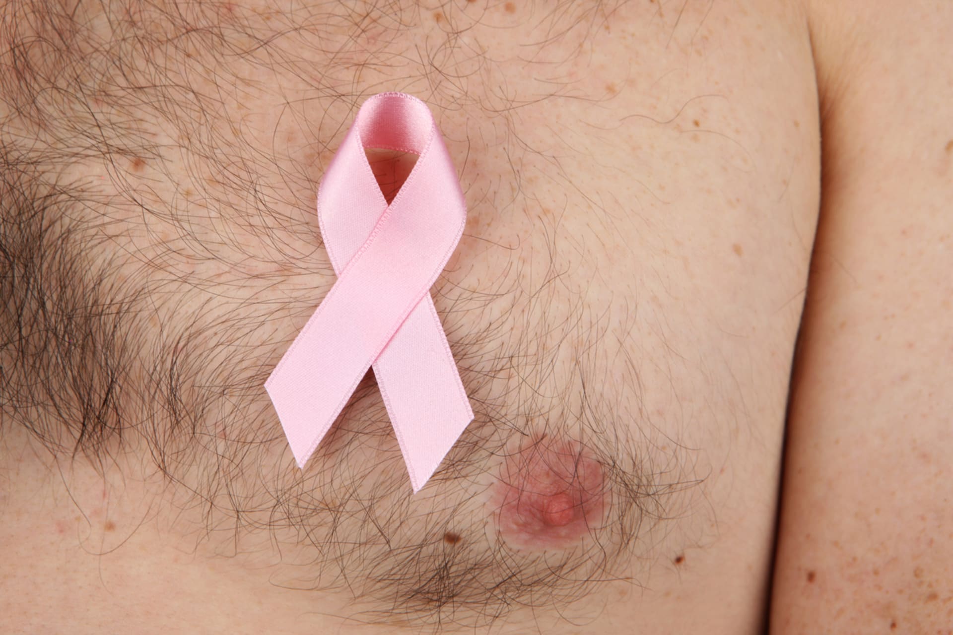Rakovina prsu u mužů 2