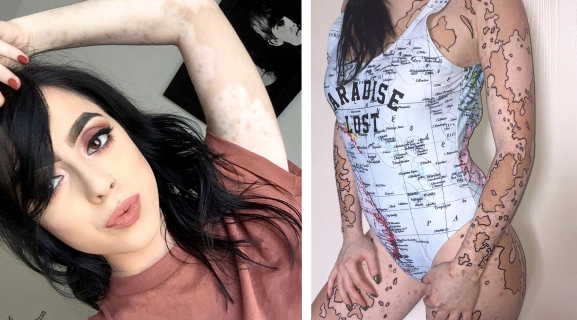 Dívka trpí nemocí vitiligo