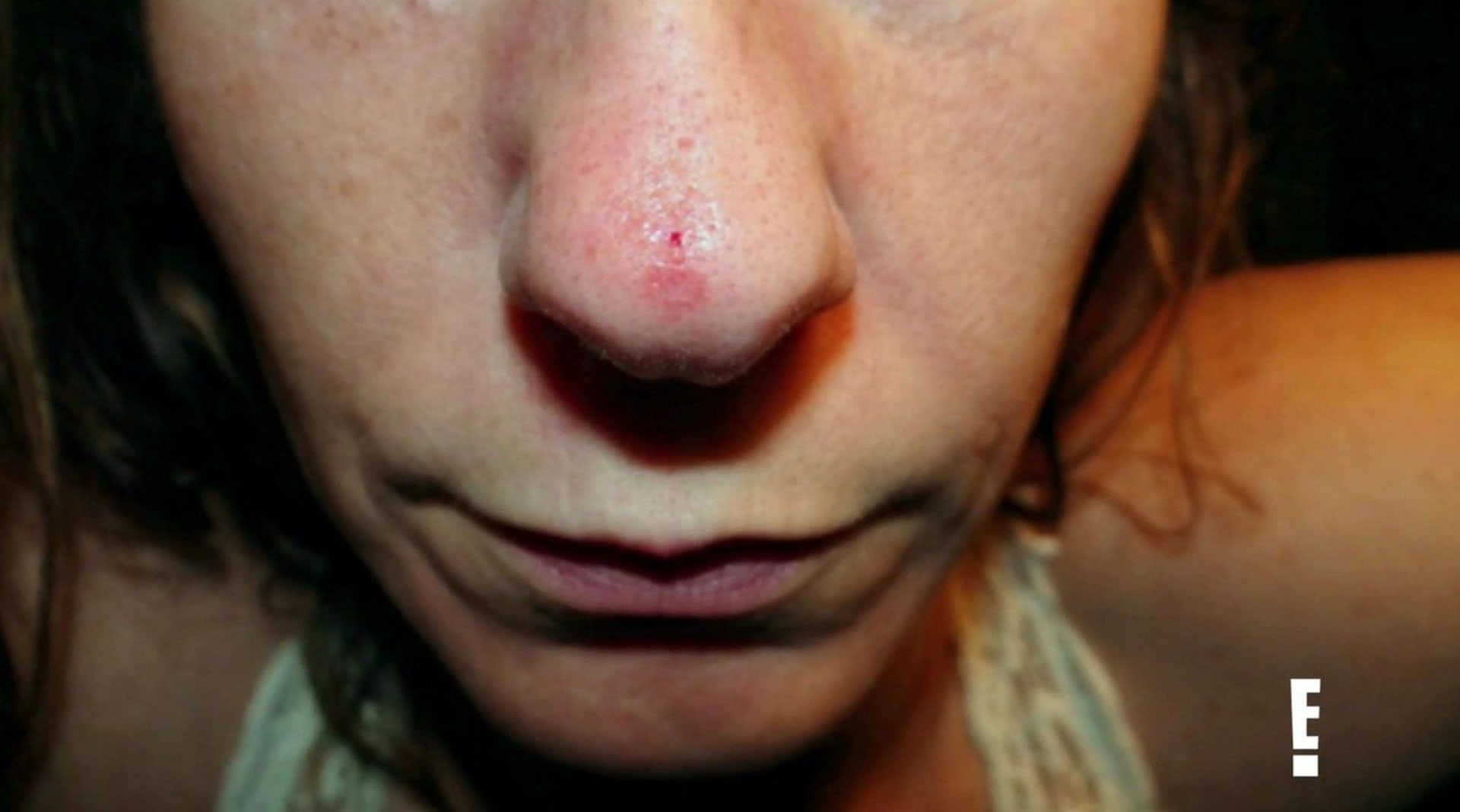 Lékaři zachránili ženě nos poté, co používala mast na rakovinu 5