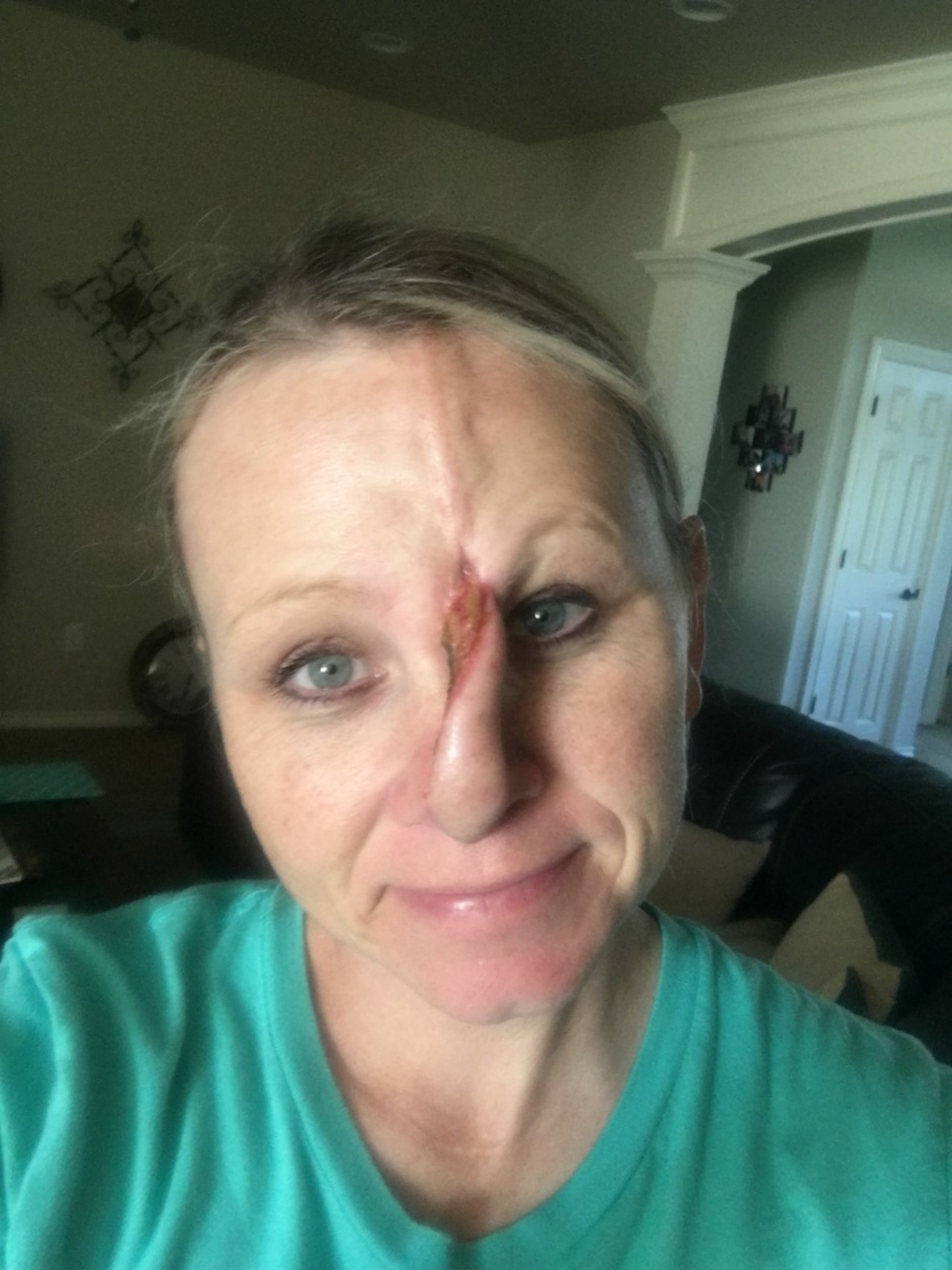 Žena s dírou v nose po rakovině kůže 4