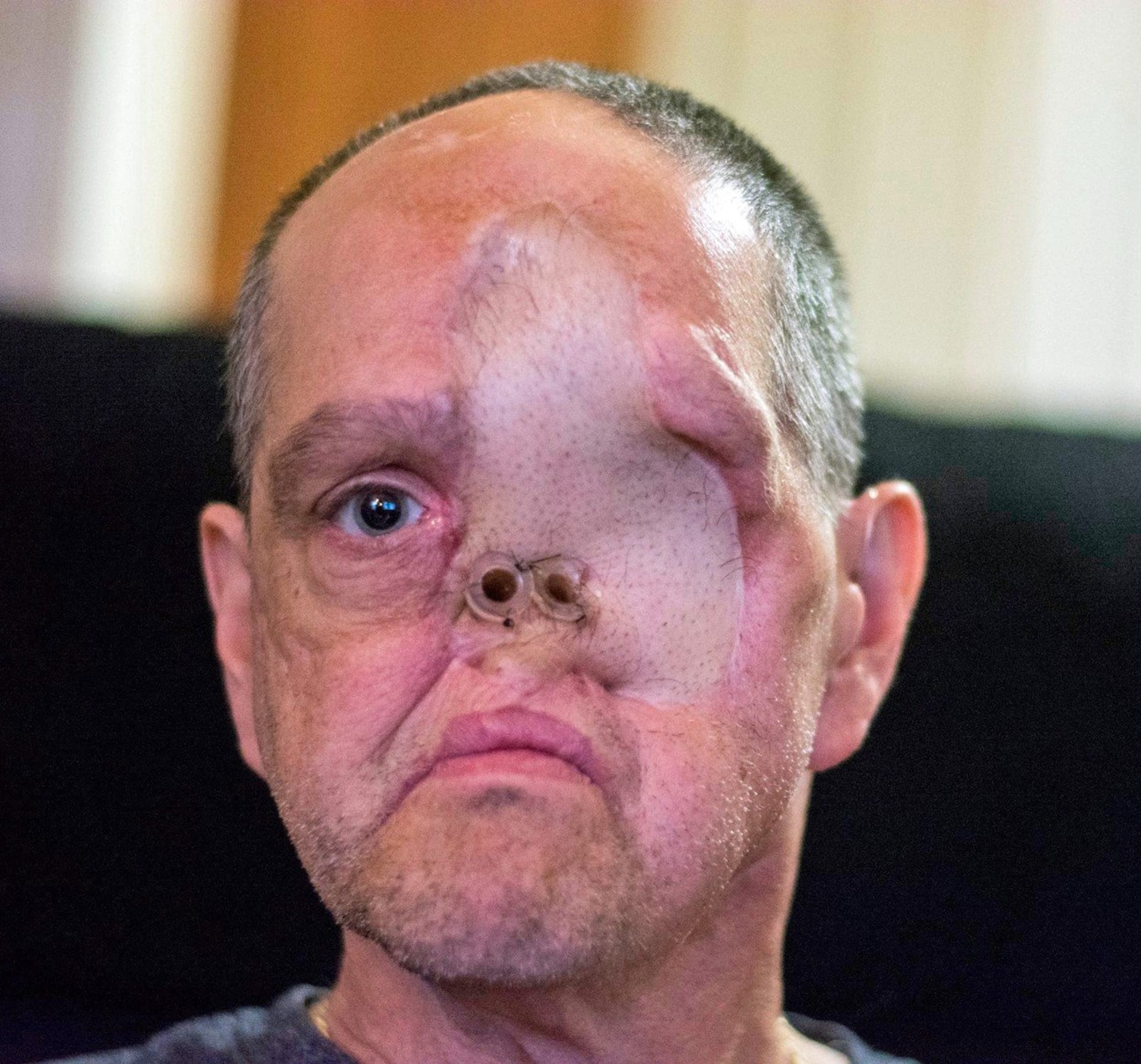 Drsné fotky - rakovina muži vzala oko, nos, i levou tvář 6