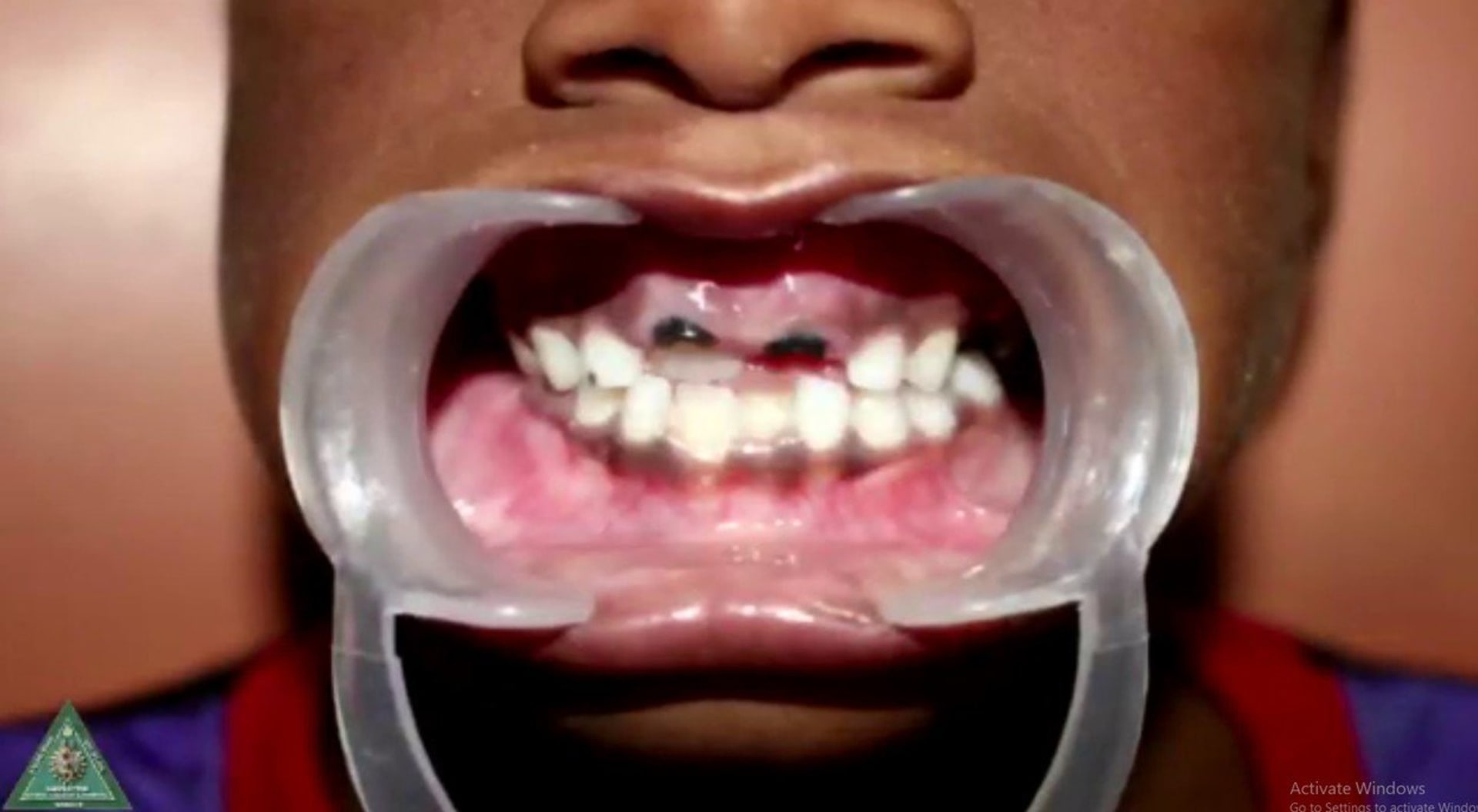 Lékaři vyoperovali chlapci z úst obří množství zubů 8