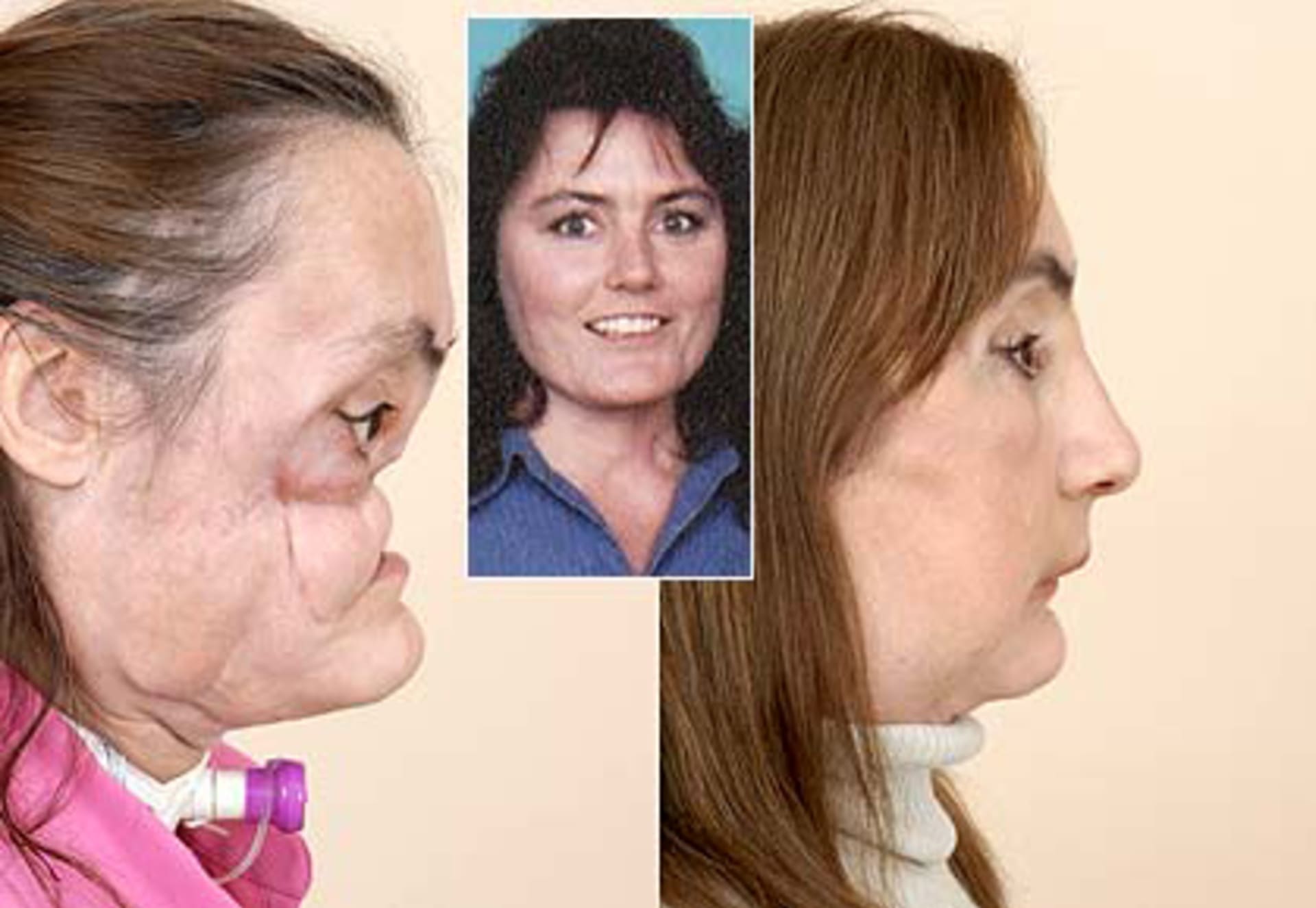 Úžasné transplantace obličeje