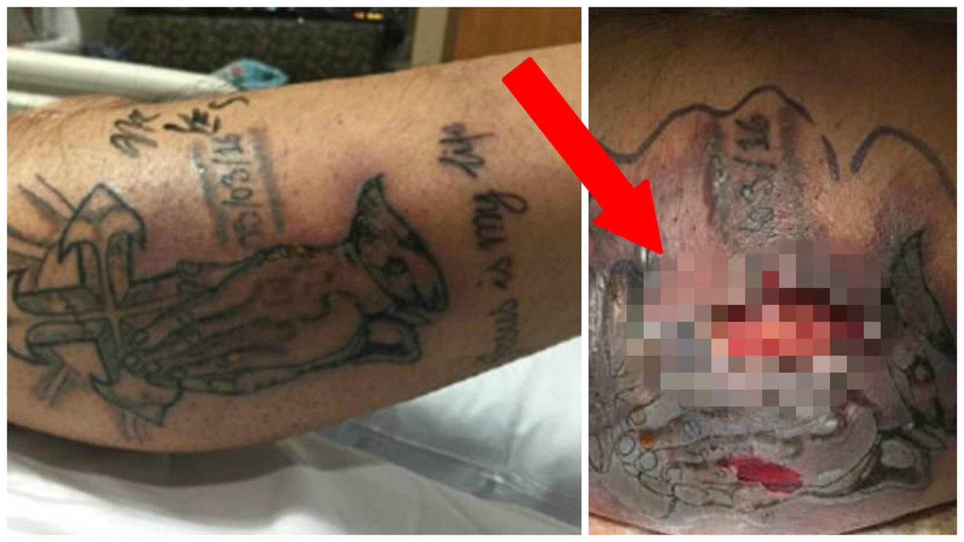 Muž zemřel kvůli novému tetování.