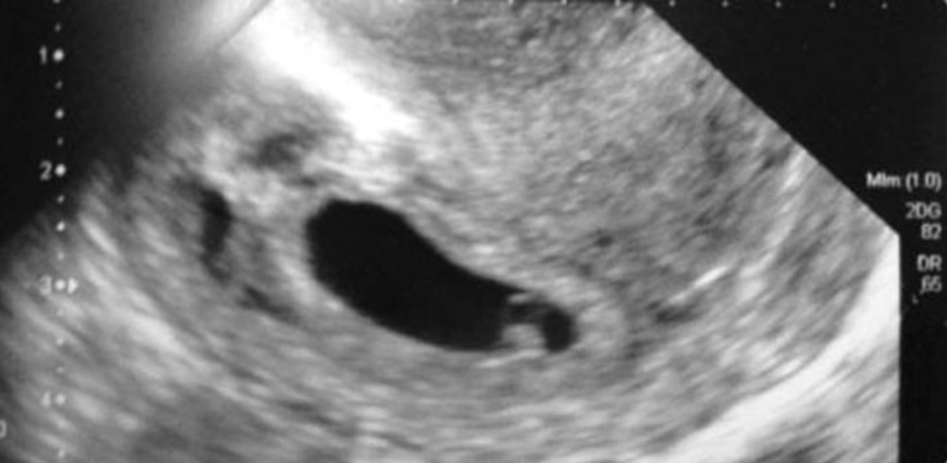 Ultrazvuky miminek, které nevypadají moc jako miminka. Báli byste se jich?