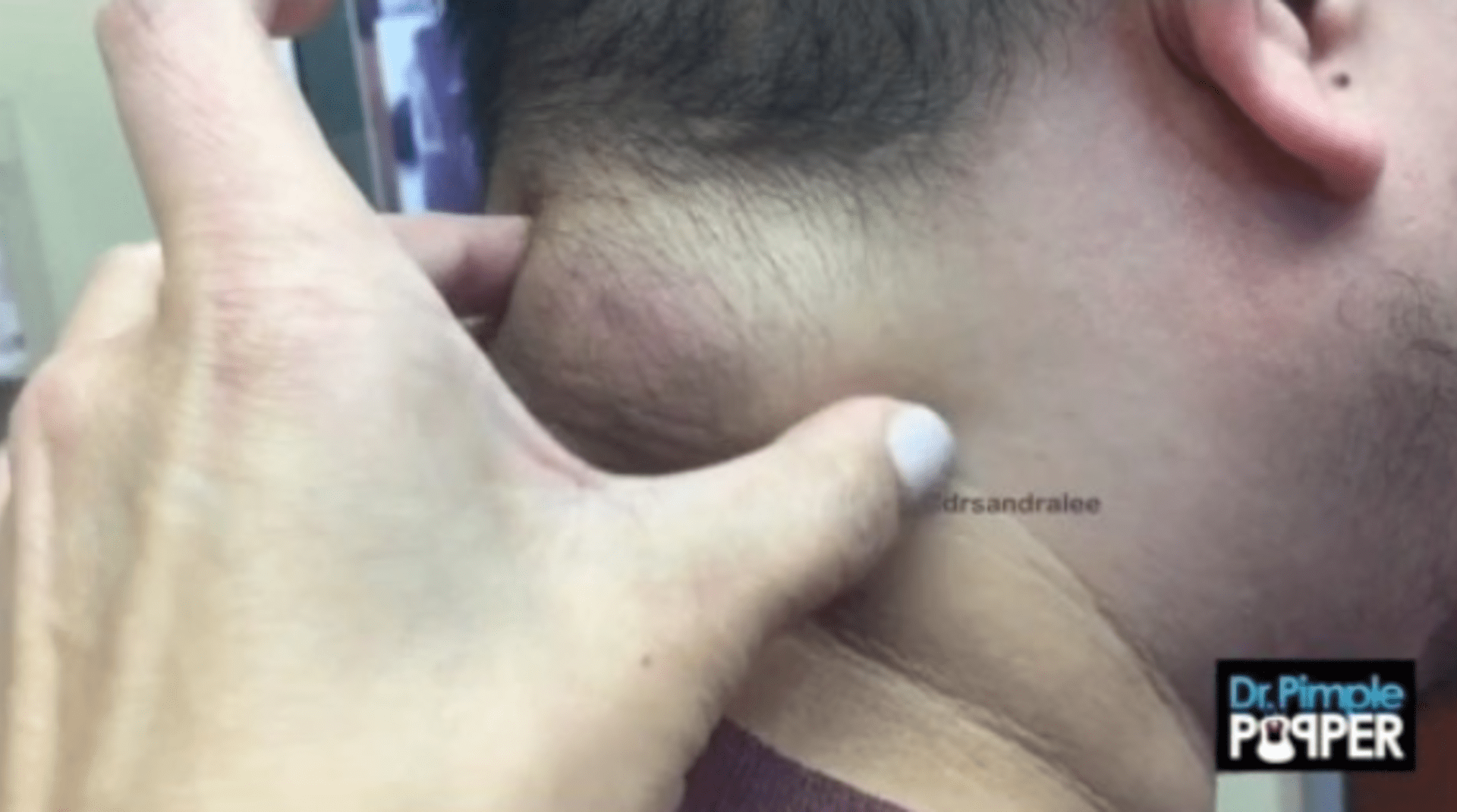 Doktorka odstranila muži obří cystu z krku