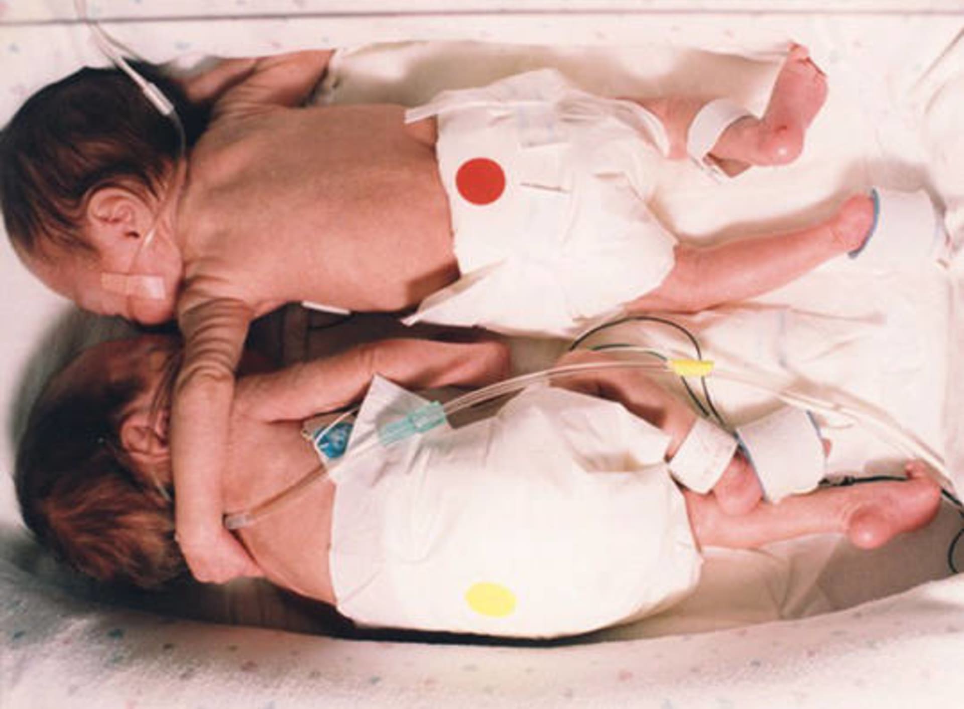 Dívka zachránila svou sestru-dvojče...těsně po porodu.