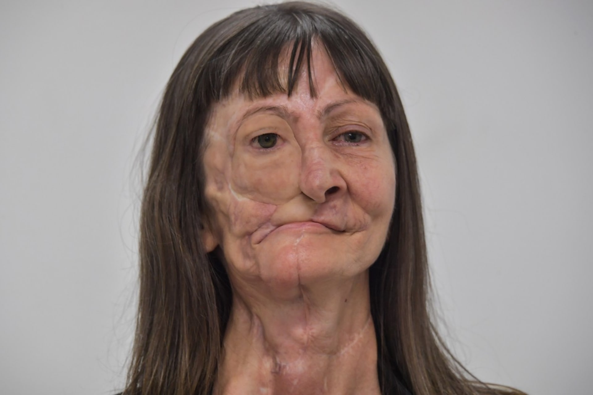Ženě s rakovinou kůže změnila život protetika 7