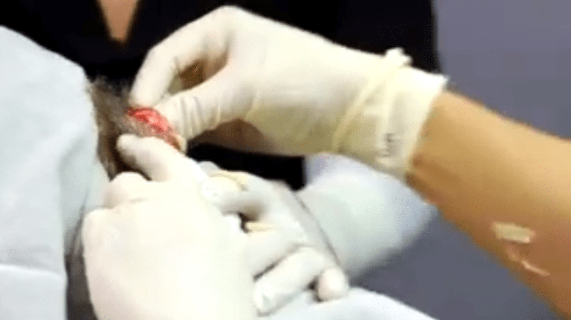 Doktorka odstranila muži z hlavy obří cystu plnou hnisu