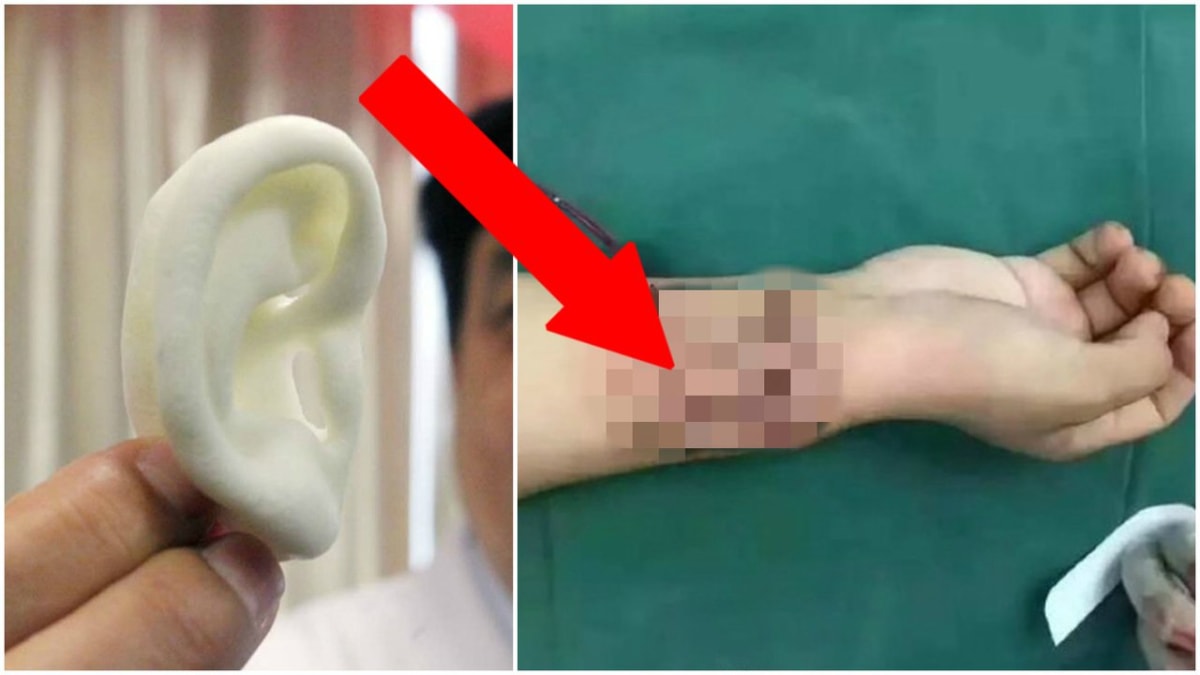 Během neobvyklého zákroku "vypěstovali" doktoři nové ucho přímo na ruce pacienta.