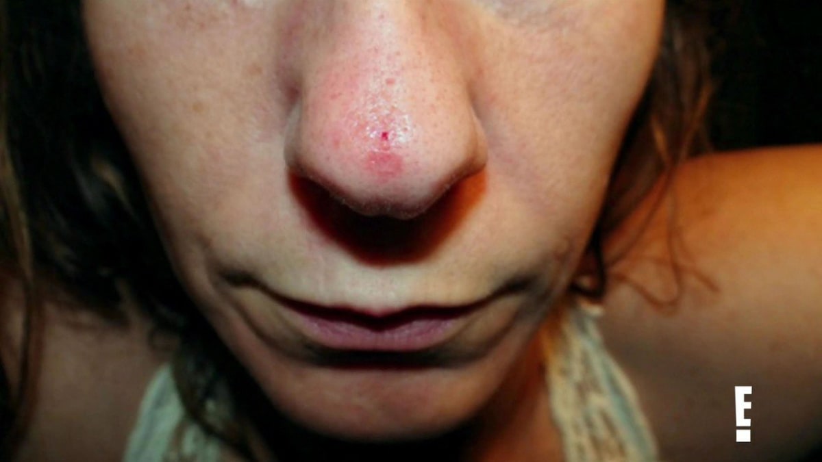 Lékaři zachránili ženě nos poté, co používala mast na rakovinu 5