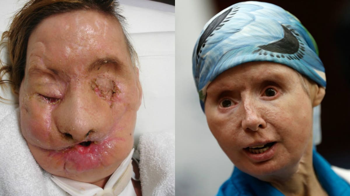Charla Nash měla obličej roztrhaný od šimpanze. Transplantaci celého obličeje prodělala rovněž v roce 2011.