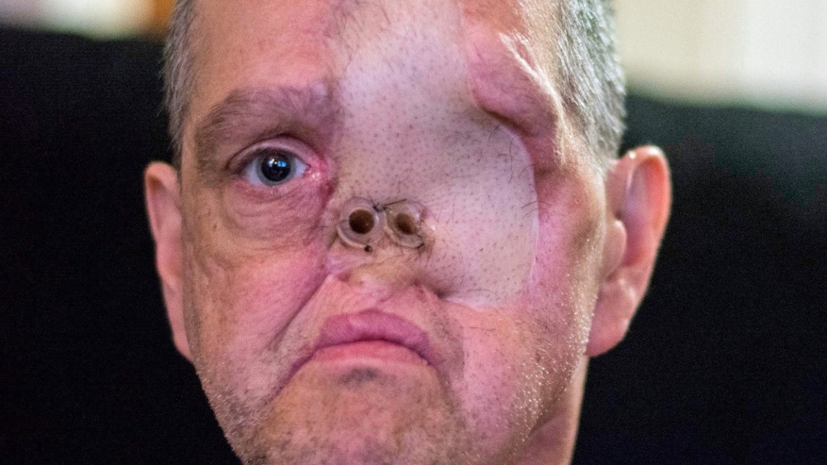 Drsné fotky - rakovina muži vzala oko, nos, i levou tvář 6