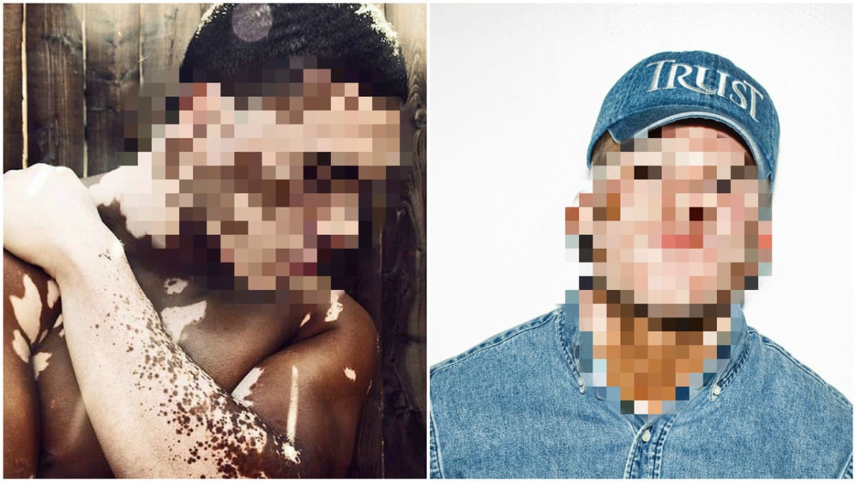 Curtis McDaniel trpí vzácnou kožní poruchou vitiligo.