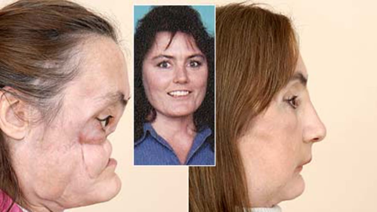 Úžasné transplantace obličeje