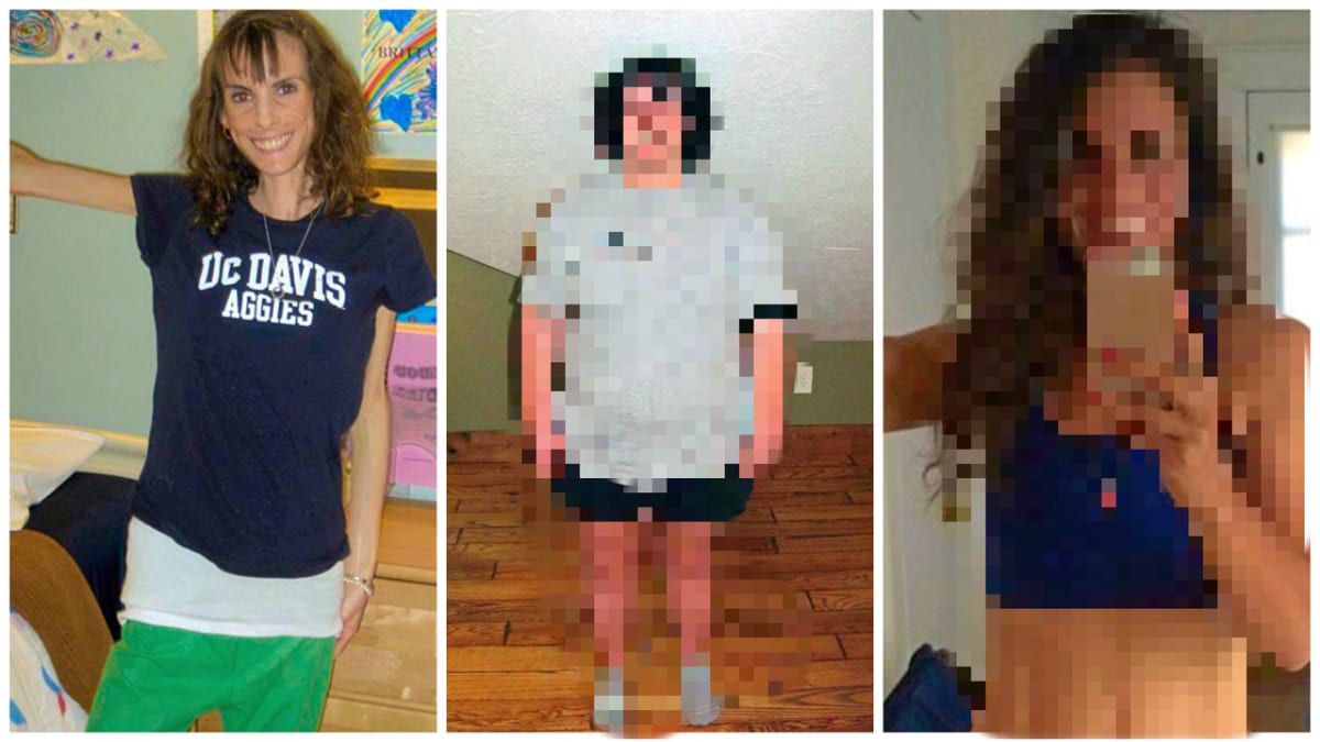 Po anorexii trpěla obezitou.