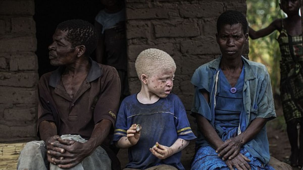 Smutný osud albínů