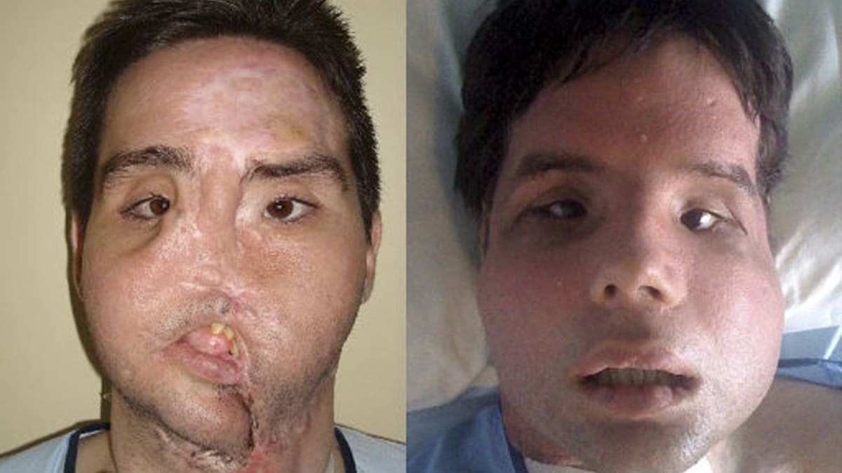 Španělský farmář Oscar se střelil do obličeje. Ten mu doktoři dokázali nakonec takhle opravit.