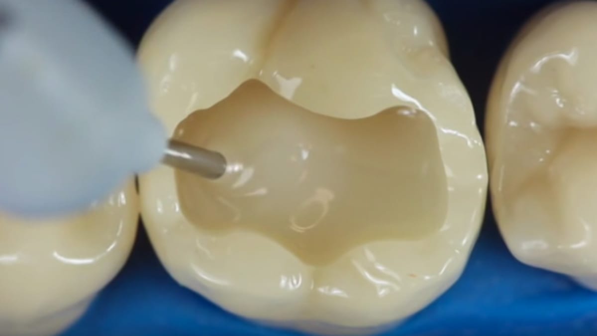 Sledujte, jak zubař opravuje totálně zničený zub
